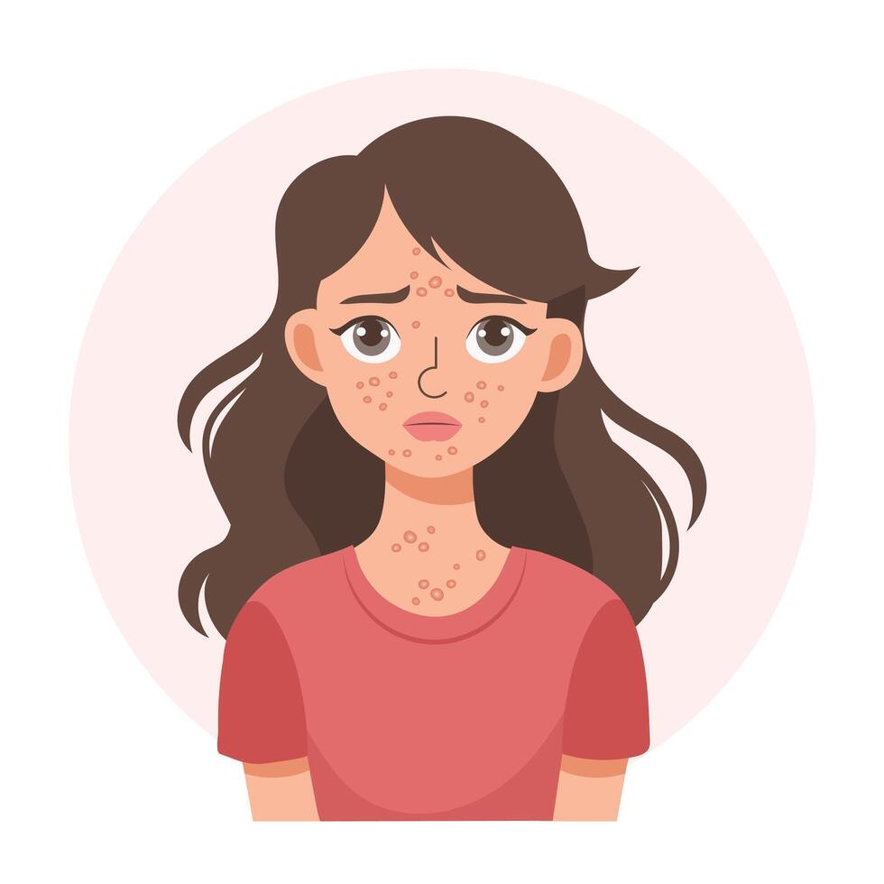 Akne. unzufrieden Teenager Mädchen mit Akne und Pickel auf ihr Gesicht. gereizt Gesichts- Haut. Illustration, Vektor