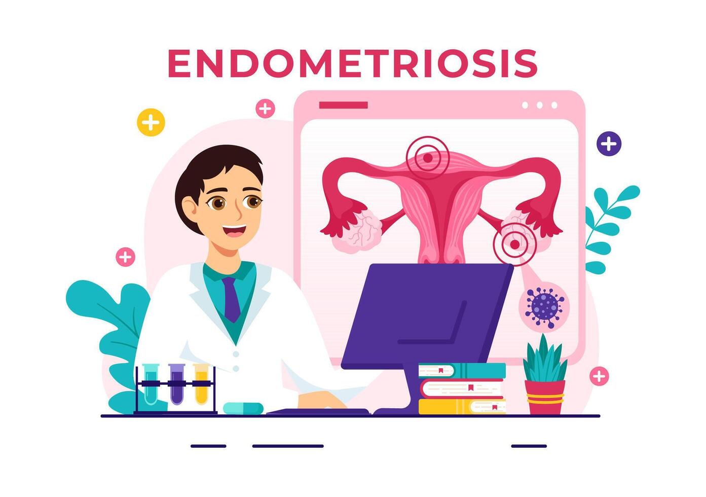Endometriose Vektor Illustration mit Bedingung das Endometrium wächst draußen das Gebärmutter- Mauer im Frauen zum Behandlung im eben Karikatur Hintergrund
