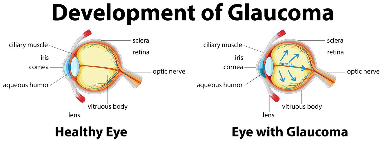 Utveckling av glaukom i mänskliga ögon vektor