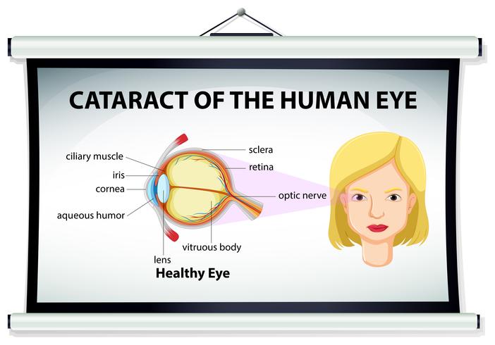 Diagramm des Katarakts im menschlichen Auge vektor