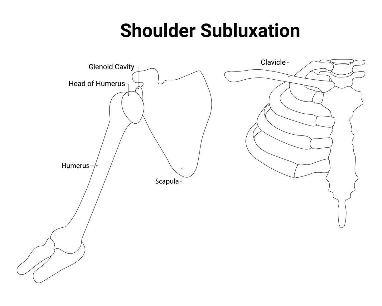 Schulter Subluxation Wissenschaft Design Vektor Illustration Diagramm