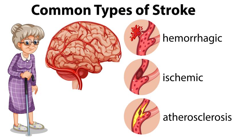 Häufige Schlaganfallarten vektor