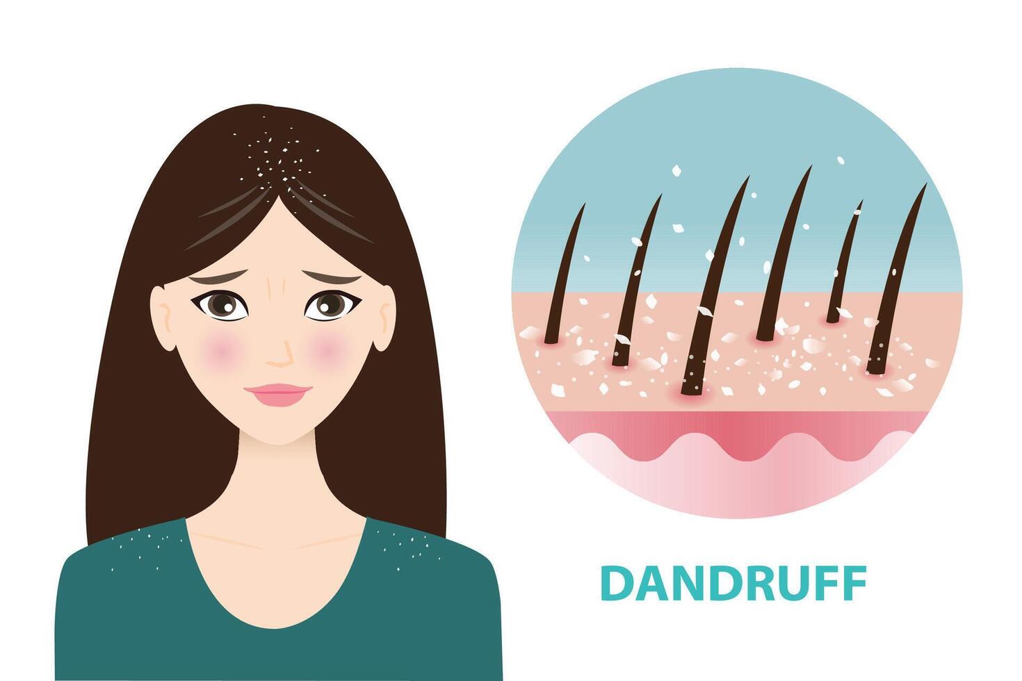 Infografik von Frau und Schuppen Symbol Vektor Illustration. das Frau ist besorgt Über Weiß trocken Flocken auf Haar und Schulter. Symbol von Schuppen, schuppig Kopfhaut im Haar. Haar Pflege und Problem Konzept.