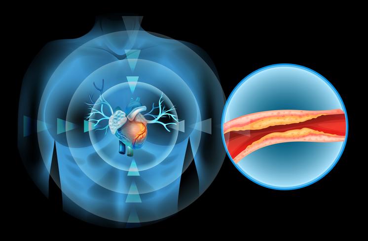 Cholesteral im menschlichen Herzen getaktet vektor