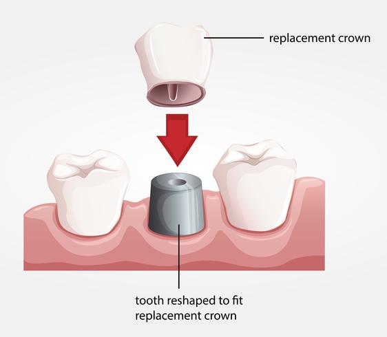 Dental crown procedur vektor