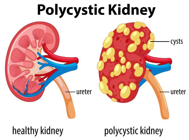 Diagram som visar polycystisk njure vektor