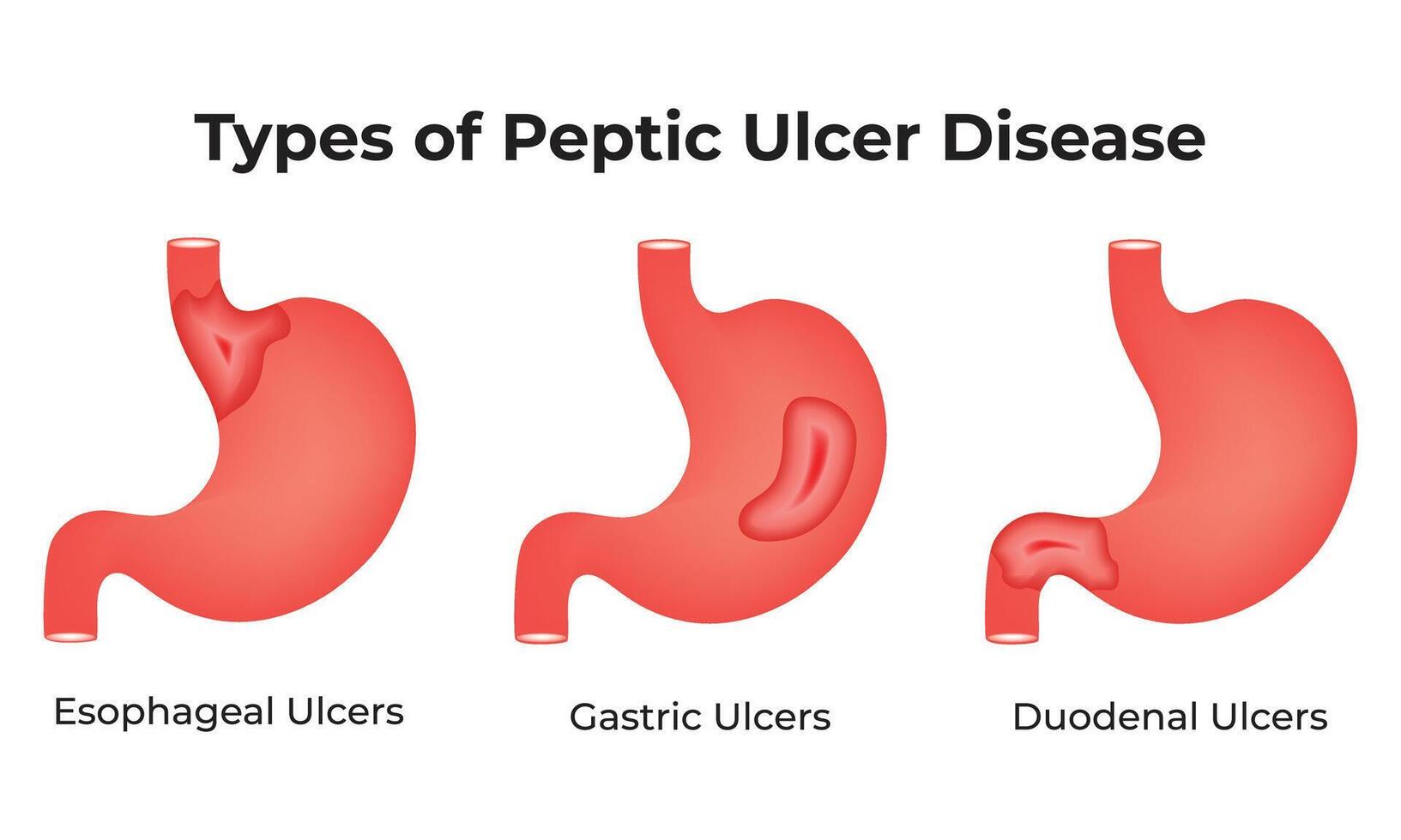 Typen von peptisch Geschwür Krankheit Wissenschaft Design Illustration vektor