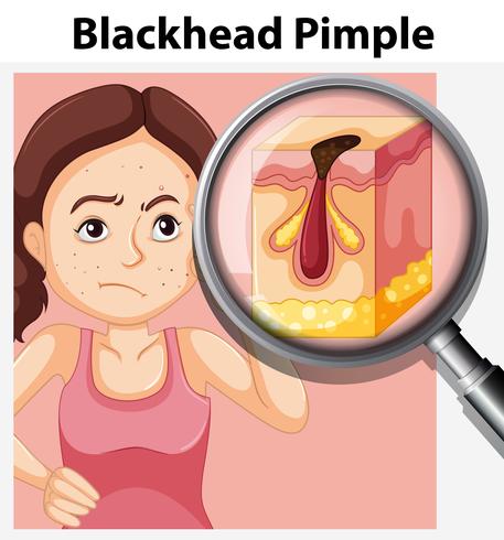 Ung kvinna med blackhead pimple vektor