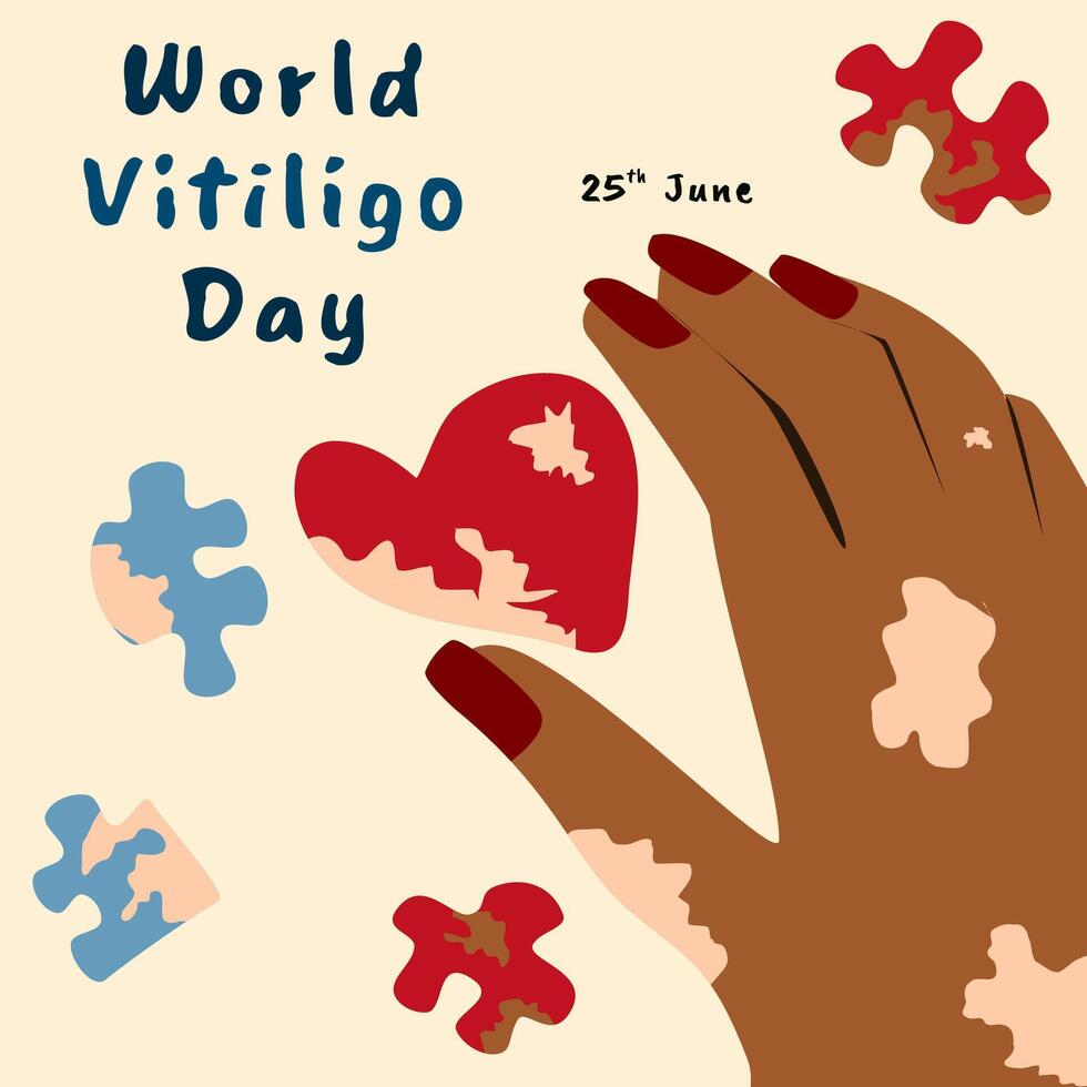 Illustration von Welt Vitiligo Tag Gruß mit bräunen Haut Hand und Puzzle Stücke vektor