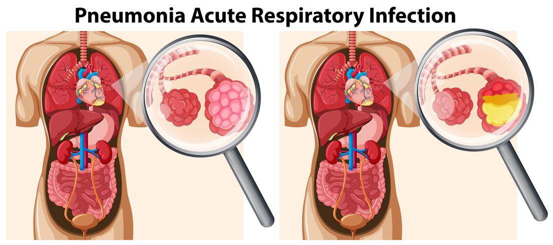 Akut respiratorisk infektion i lunginflammation vektor