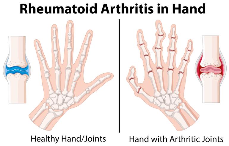 Diagramm, das rheumatoide Arthritis in der Hand zeigt vektor