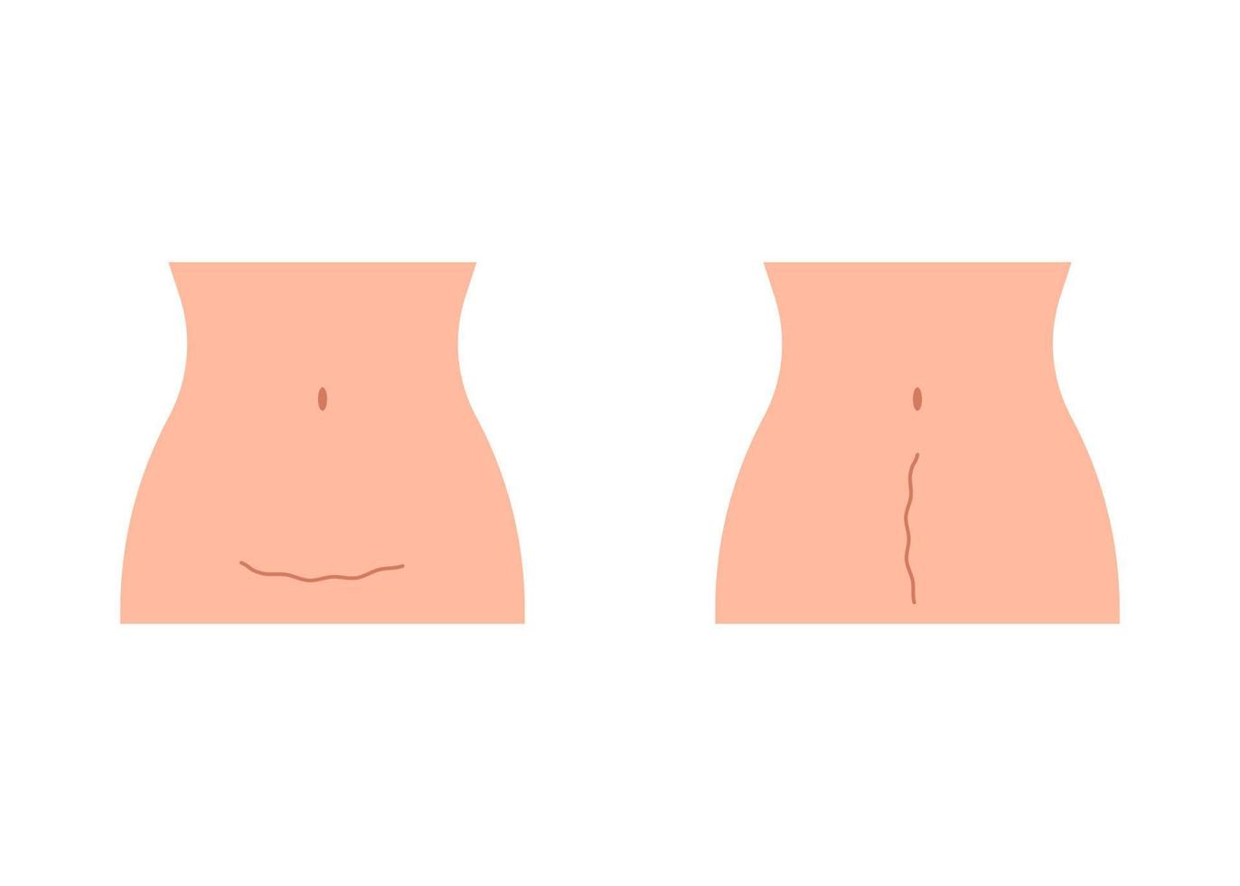 ärr på magen kvinna efter kejsarsnitt. kvinnas mage, konsekvens kejsarsnitt. moderskap, förlossning. vektor illustration