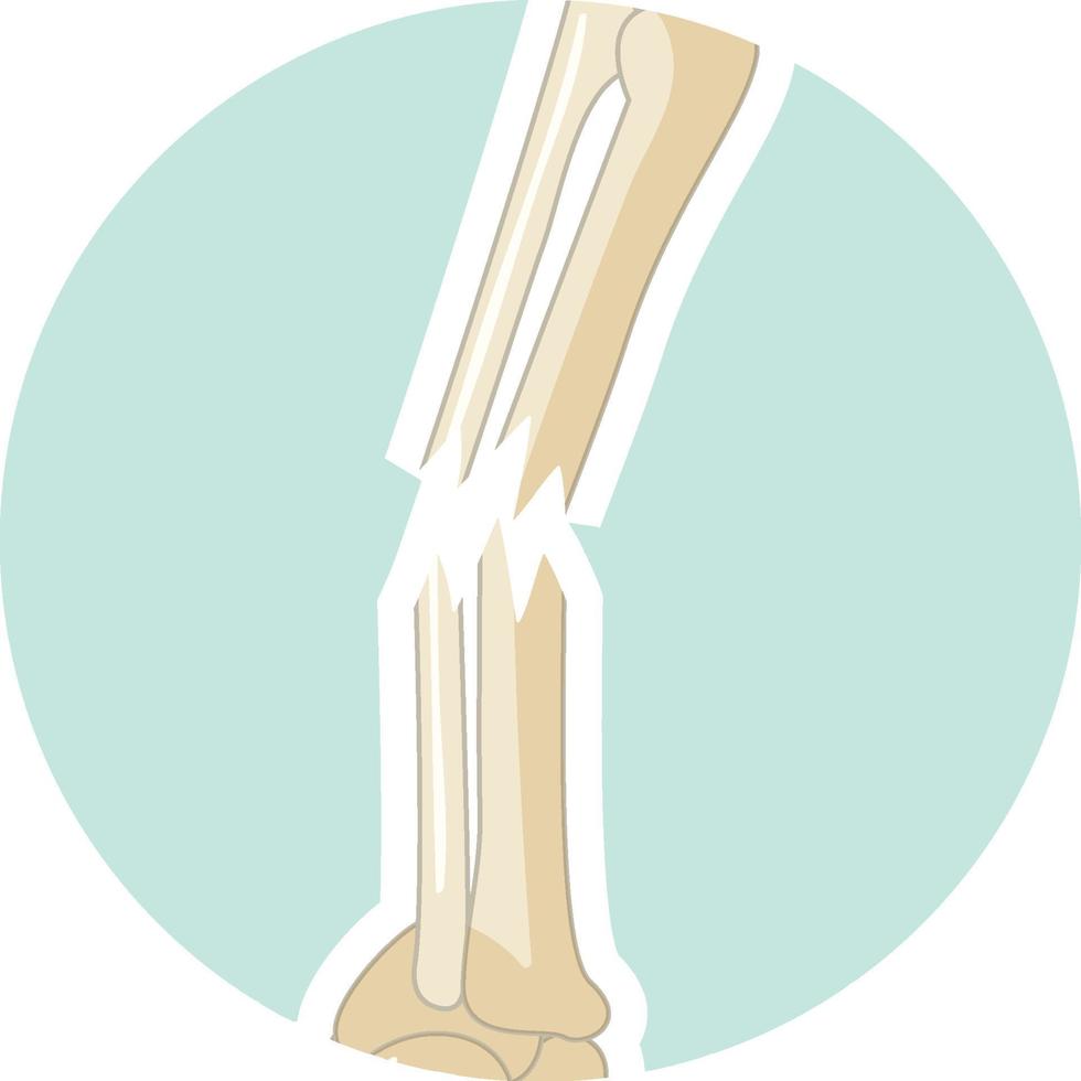 mänskligt brutet ben i tecknad stil vektor