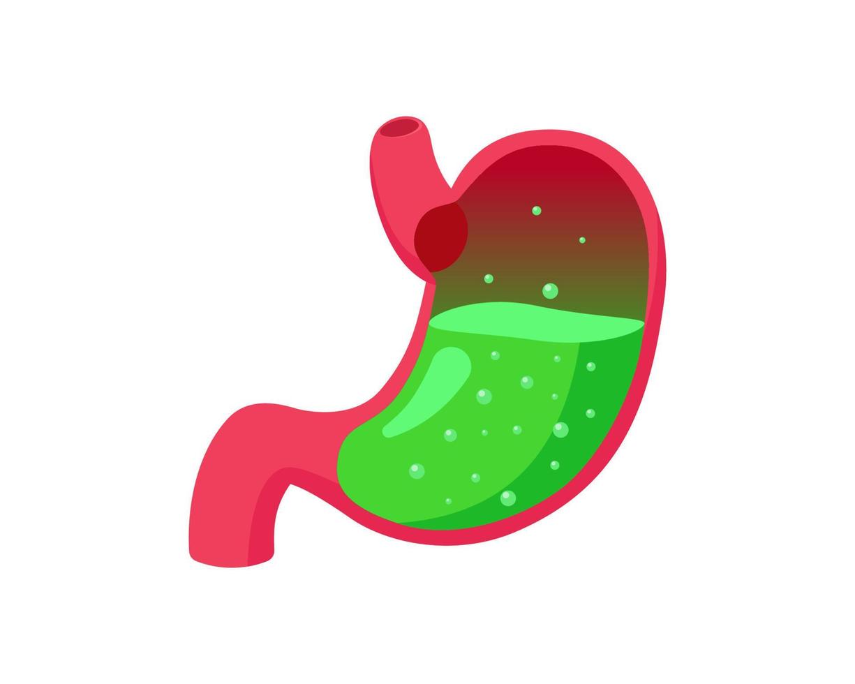 Magengerd oder Vergiftung mit grüner flüssiger Säure im Inneren. gastroösophageale Refluxkrankheit. Verdauungssystem Sodbrennen Problem. Übelkeit und Verdauungsstörungen. Bauchschmerzen medizinische Illustration vektor