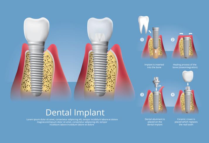 Menschliche Zähne und Zahnimplantat-Vektor-Illustration vektor