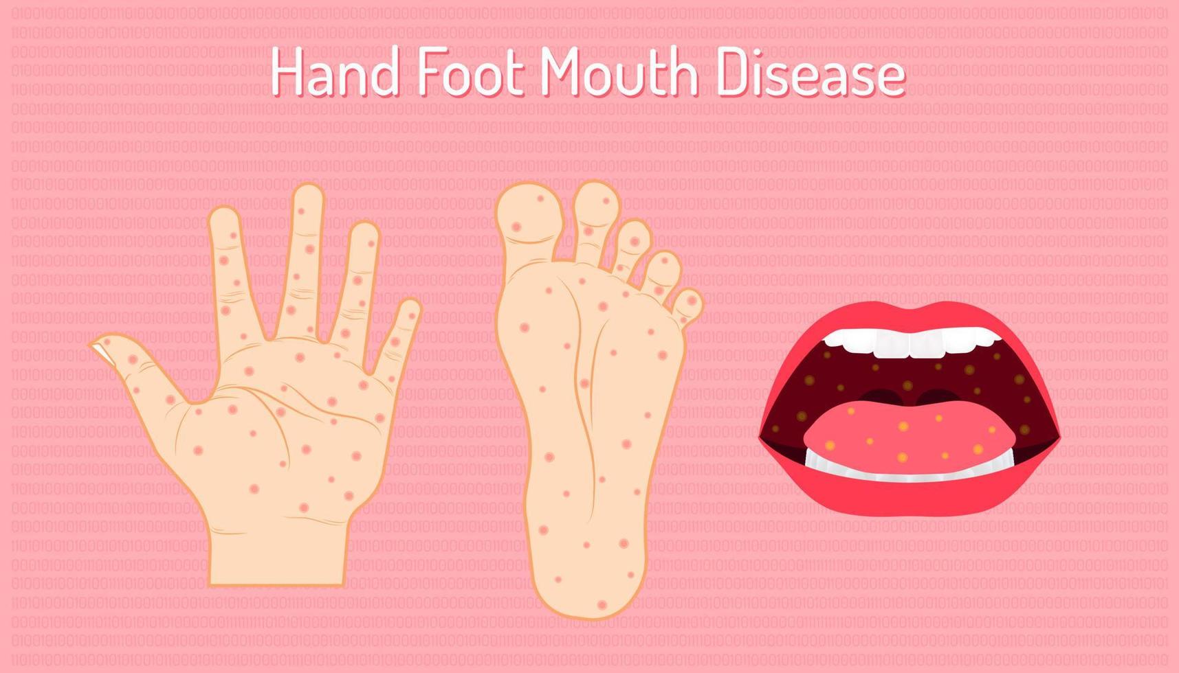 hand fot mun syndrom. coxsackie virus a16, enterovirus 71. vektorillustration eps10 vektor