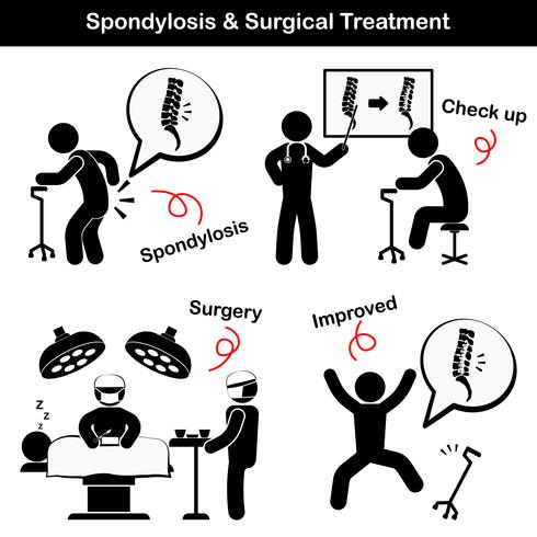 Spondylose und Spondylolisthesis und chirurgisches Behandlungspiktogramm (Alter Mann leidet an Kreuzschmerzen (Lendenschmerzen), er wurde untersucht und operiert, die Wirbelsäule wurde intern durch Platte und Schraube fixiert) vektor