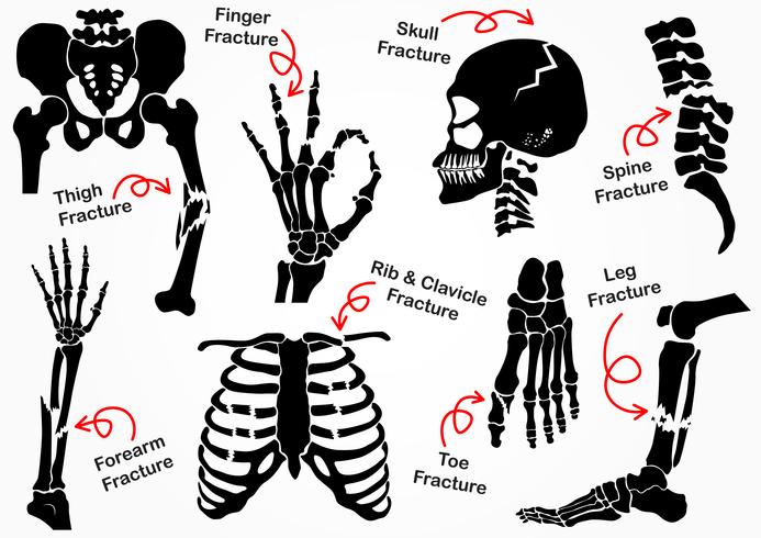 Set Bone Fracture Icon (Becken, Hüfte, Oberschenkel, Hand, Handgelenk, Finger, Schädel, Gesicht, Wirbel, Arm, Ellbogen, Thorax, Fuß, Ferse, Bein) Schwarzweiß-Design (Gesundheitskonzept) vektor