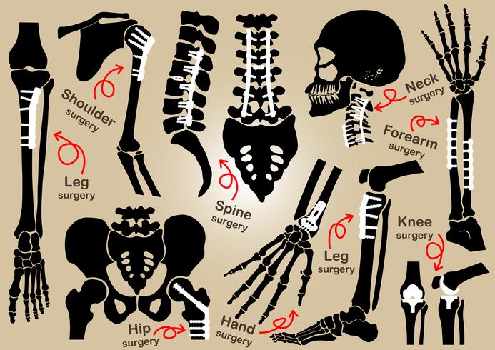 Sammlung orthopädischer Eingriffe (interne Fixierung durch Platte und Schraube) (Schädel, Kopf, Hals, Wirbelsäule, Kreuzbein, Arm, Unterarm, Hand, Ellbogen, Schulter, Becken, Oberschenkel, Hüfte, Knie, Bein, Fuß) vektor