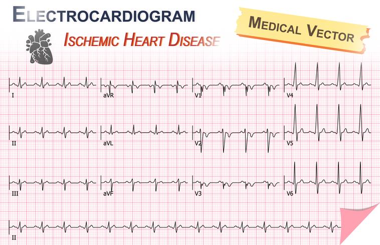 Elektrokardiogram (EKG, EKG) av ischemisk hjärtsjukdom (hjärtinfarkt) och hjärtatikettens anatomi vektor