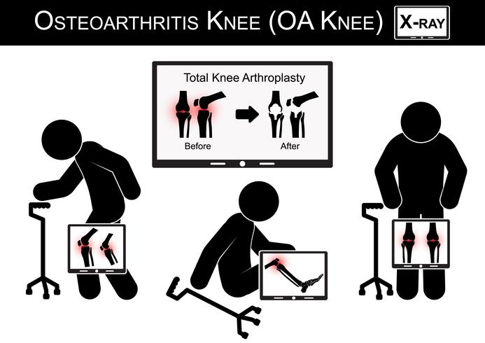 Alter Mann Schmerzen am Knie, Monitor zeigen Bild von Total Knieendoprothese (vor und nach der chirurgischen Behandlung) Arthrose Knie Vektor (flache Bauform) (Health Care-Konzept)