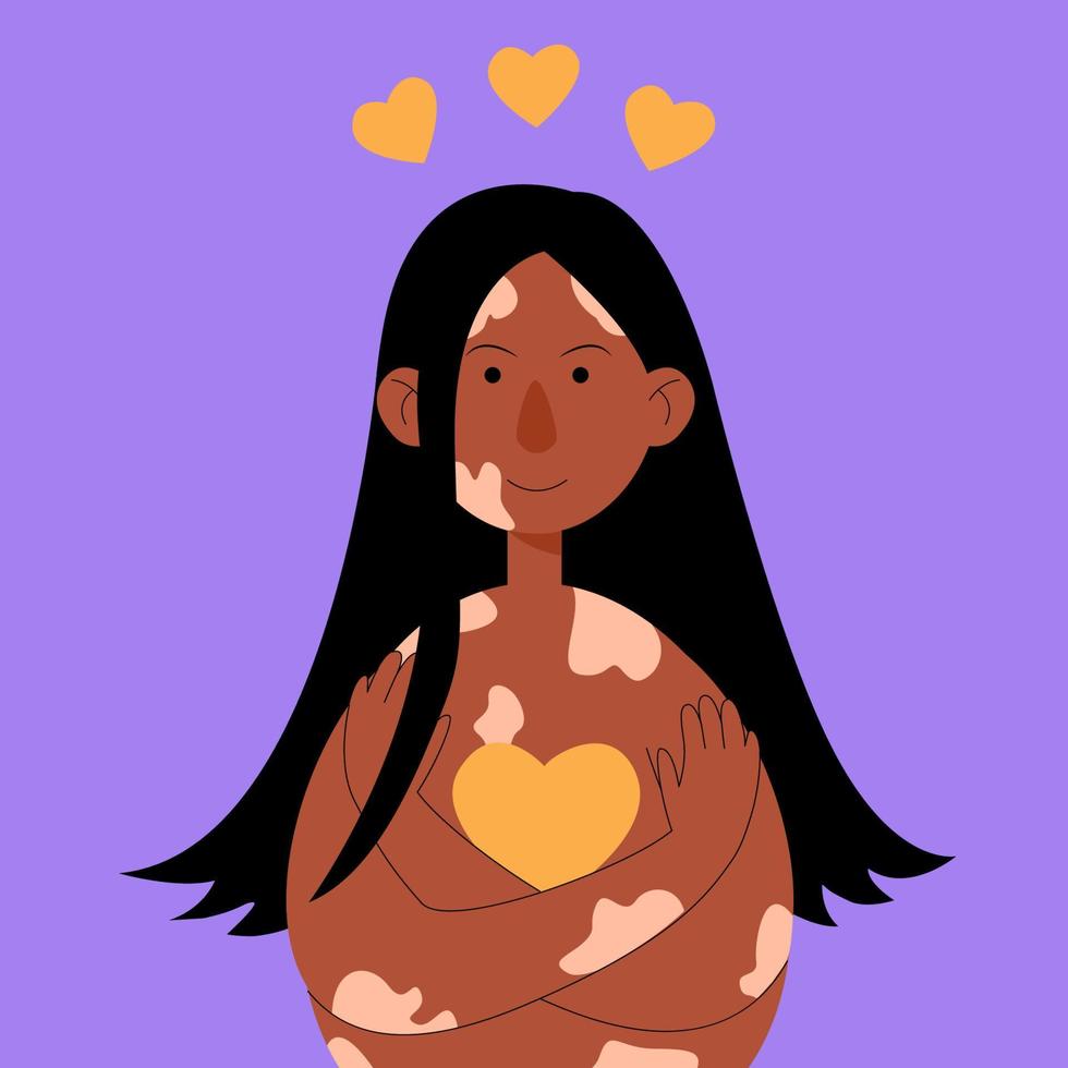 Mädchen mit Vitiligo umarmt sich und ihren Körper, sie liebt sich selbst. konzeptkörper positive frau im flachen karikaturstil. isoliert auf einem lila Hintergrund. vektor