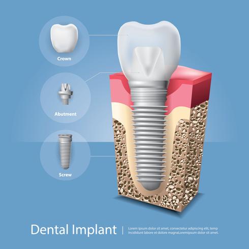 Mänskliga tänder och Dentalimplantat Vektorillustration vektor