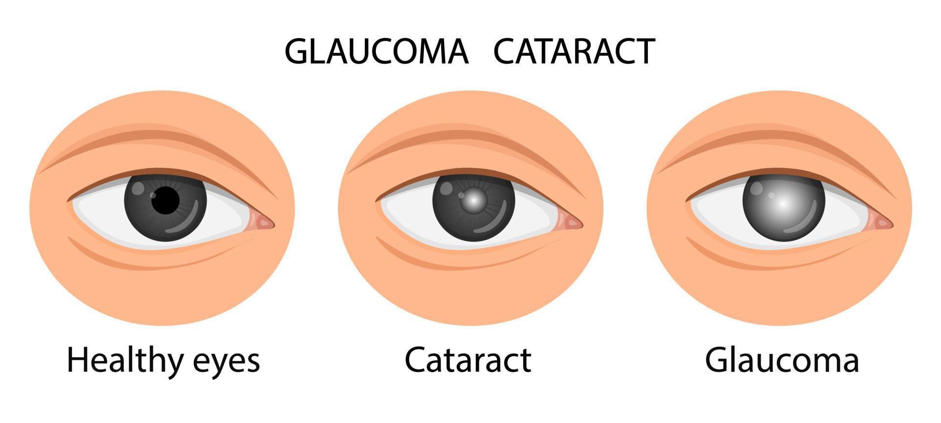 illustration av ett friskt öga, glaukom, grå starr. vektor