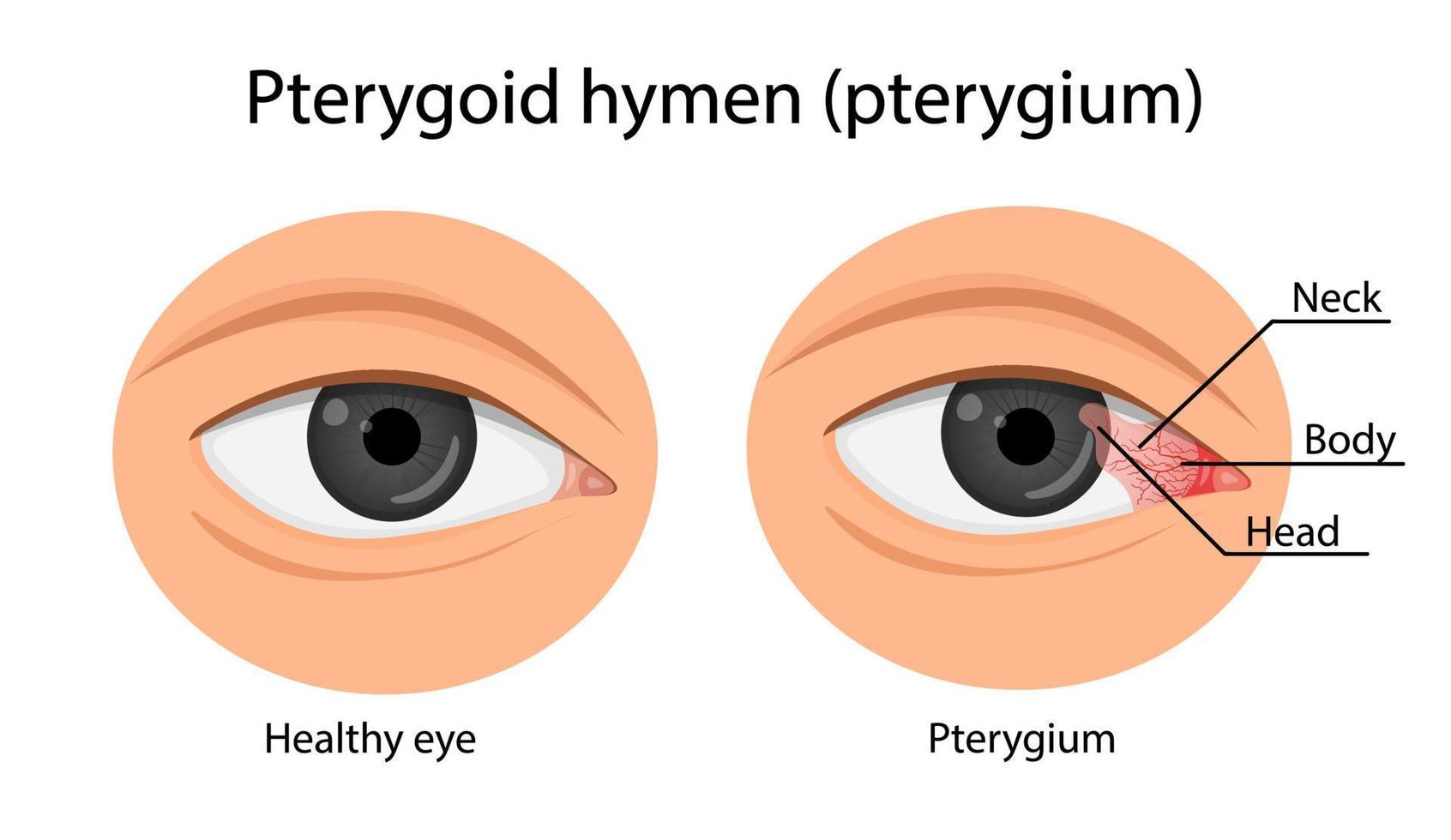 pterygium växer på hornhinnan. ögonsjukdom. tecknad vektorillustration. vektor