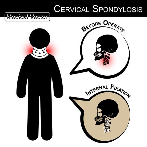 Stick Mann mit hartem Kragen. Zervikale Spondylose. vektor