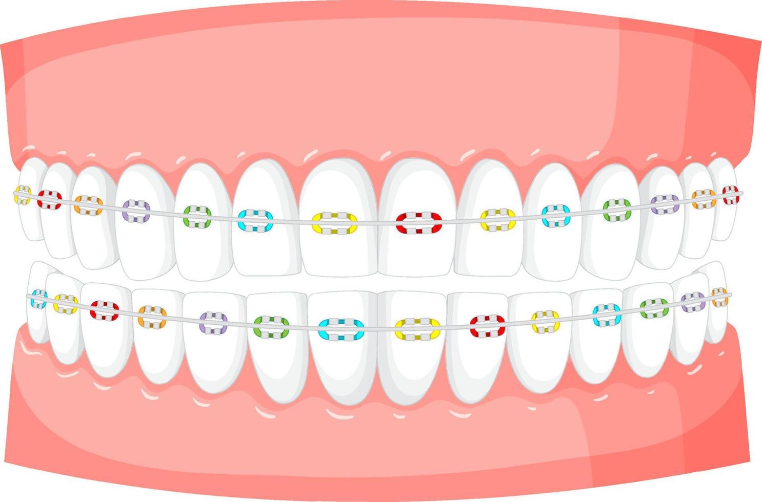 Zahnspange auf einem Modell menschlicher Zähne auf weißem Hintergrund vektor