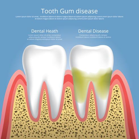 Menschliche Zähne Stadien der Zahnfleischerkrankungs-Vektor-Illustration vektor