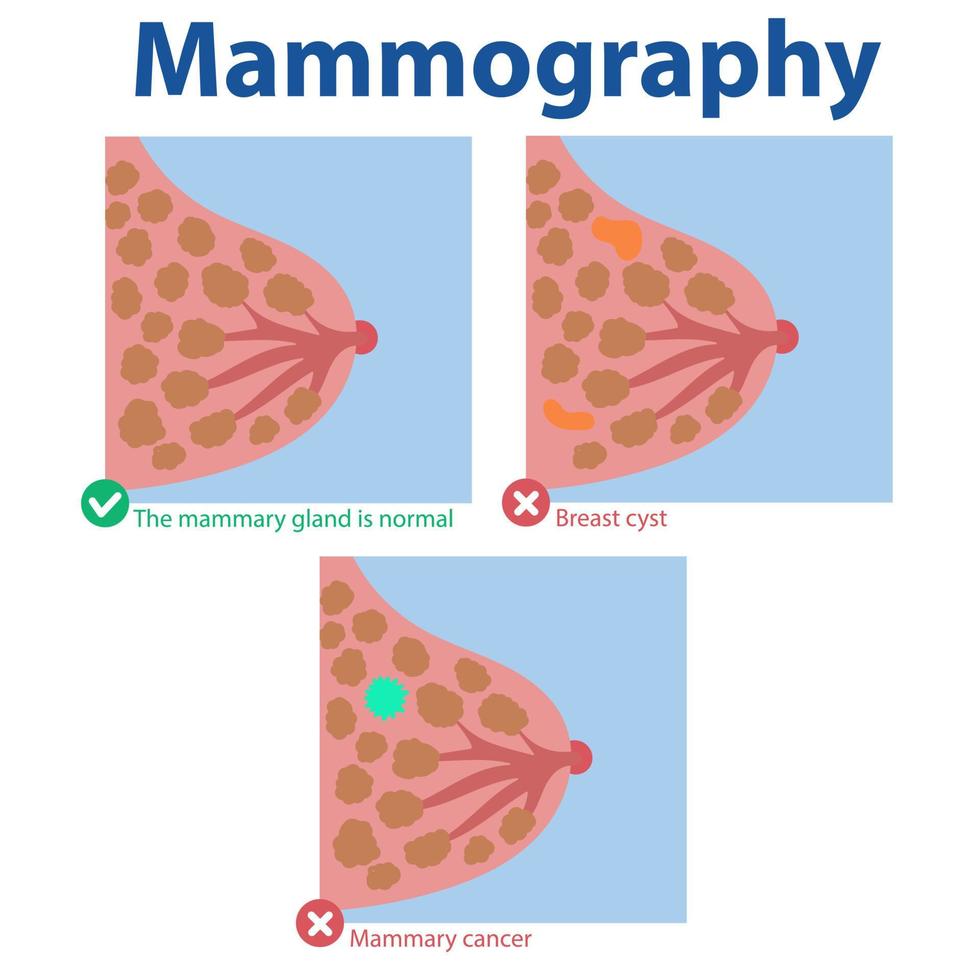 Mammographie. die Ergebnisse der ärztlichen Untersuchung normale Brust, Brustzyste, Brustkrebs vektor