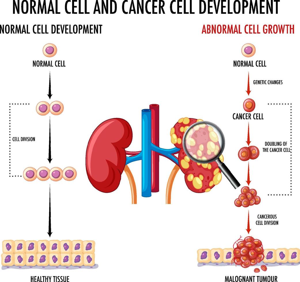 diagram som visar cancerutvecklingsprocessen vektor