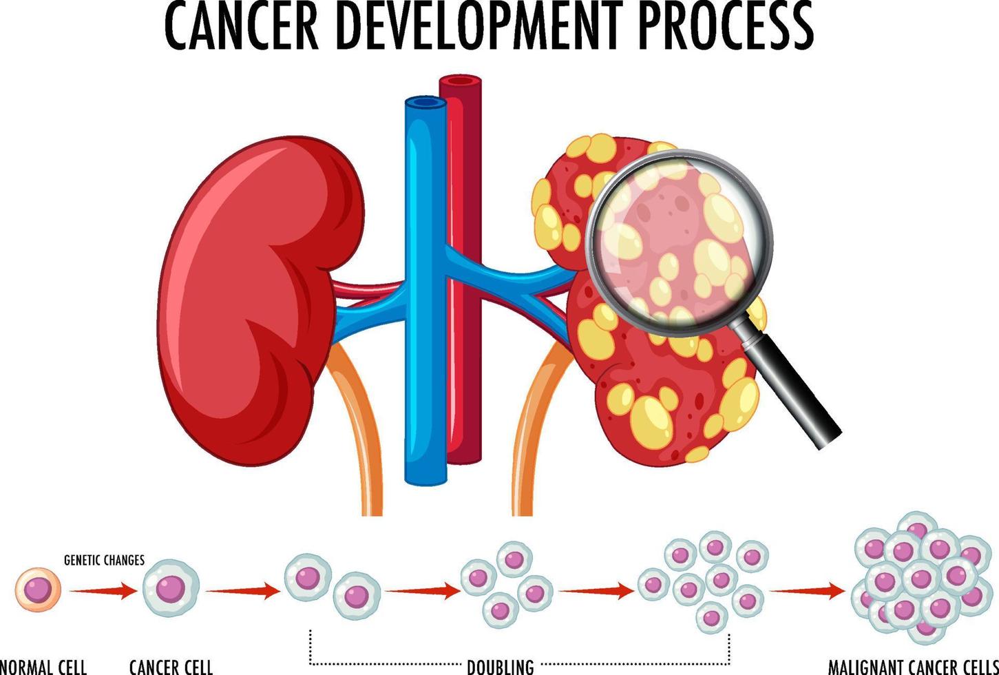 Diagramm, das den Krebsentwicklungsprozess zeigt vektor