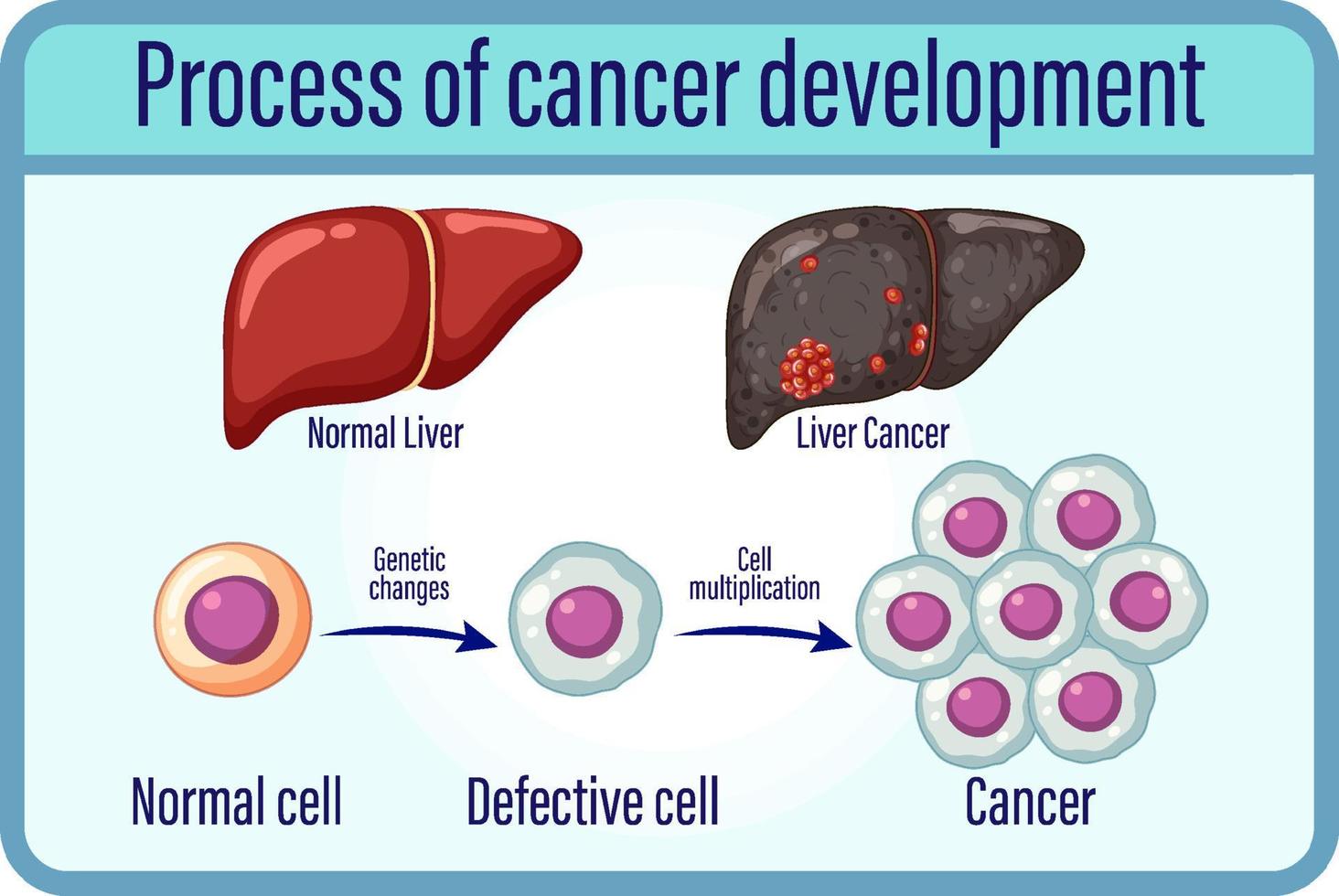 cancerutvecklingsprocessen vektor