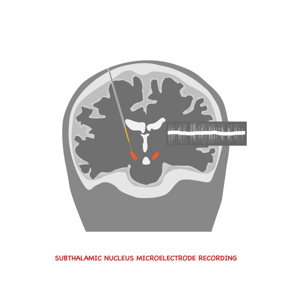 Gehirnaufzeichnung im subthalamischen Nucleus für die Parkinson-Krankheitsoperation. vektor