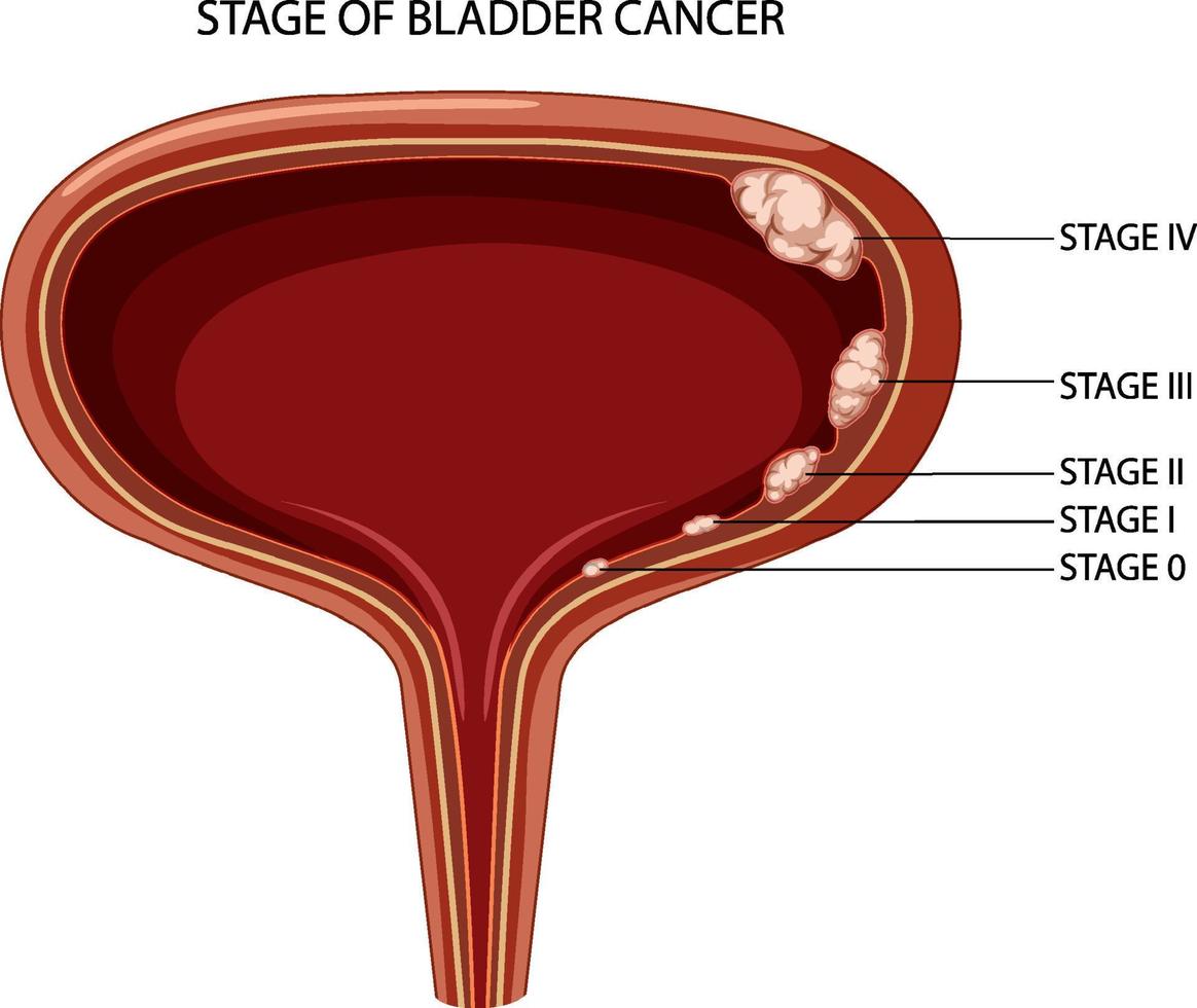 Stadium von Blasenkrebs vektor