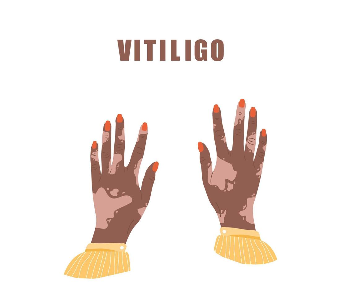 afrikanska kvinnliga händer med vitiligo. världsvitiligodagen. hudsjukdom. självvård och självkärlek. vektor illustration i platt tecknad stil