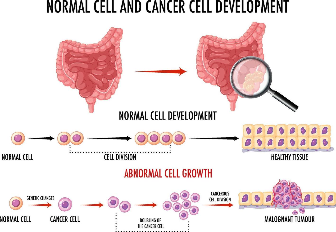 diagram som visar normala celler och cancerceller vektor