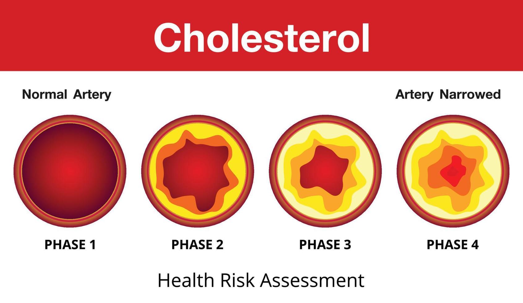 Cholesterin in der Arterie, Gesundheitsrisiko, Vektordesign vektor