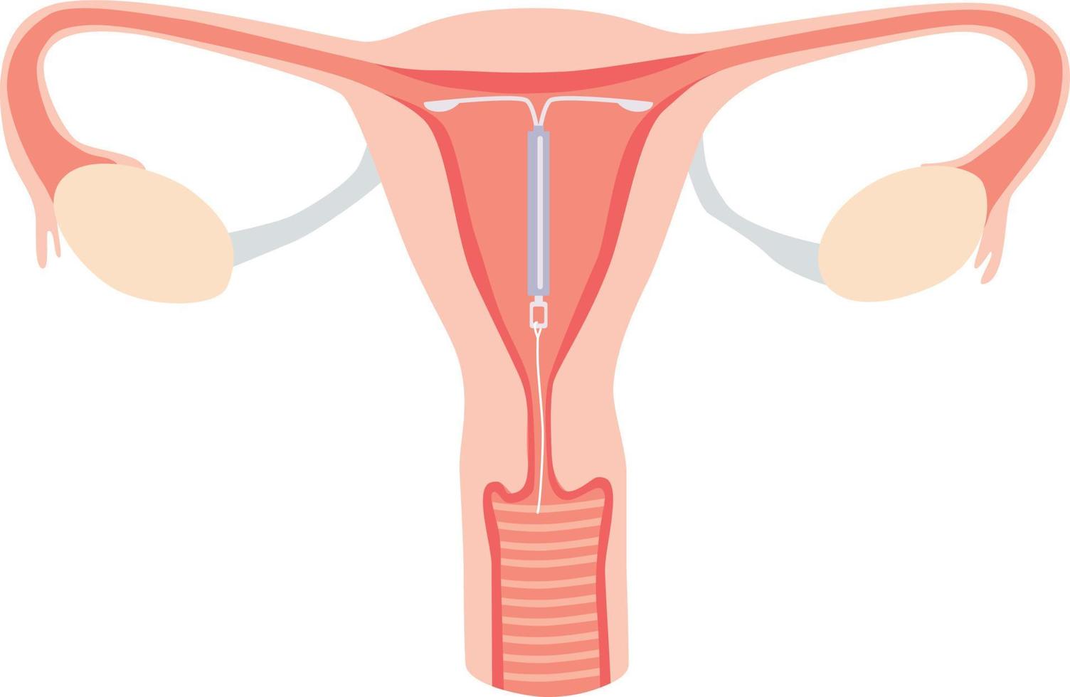 das Intrauterinpessar in der Gebärmutter. weibliche Verhütung. vektor