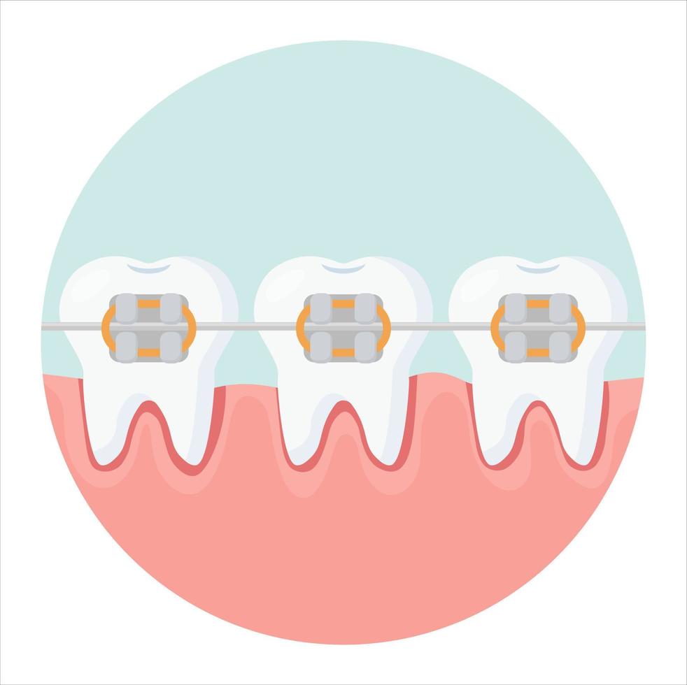 tänder ikon med hängslen på en blå bakgrund. ortodontisk behandling, tanduträtning med tandställning. vektor