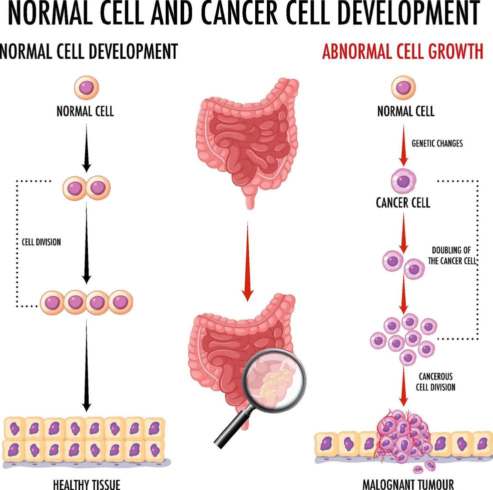 diagram som visar normala celler och cancerceller hos människa vektor