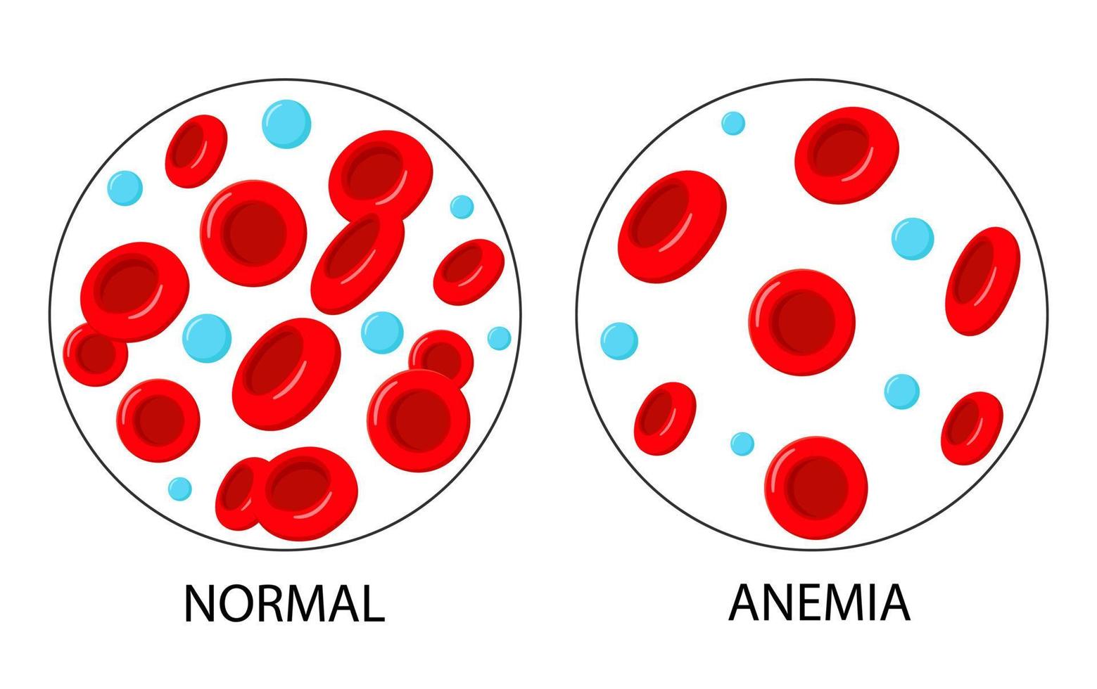 Der Unterschied bei Anämie ist die Anzahl der roten Blutkörperchen und die Norm. vektor