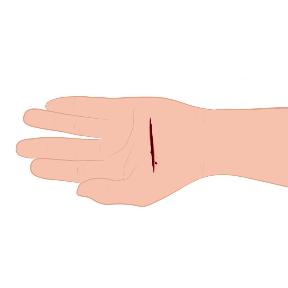 Verletzte Hand mit blutender Schnittwunde mit Wunde auf der Handflächenvektorillustration vektor