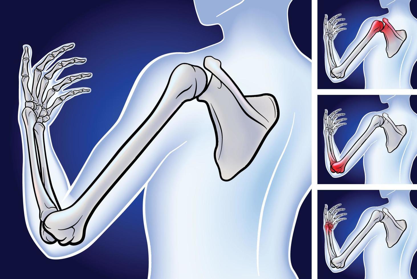 3D-Darstellung des Knochens vom Schulterblatt bis zur Fingerspitze, die die Position von drei Schmerzpunkten auf dunkelblauem Hintergrund zeigt. vektor