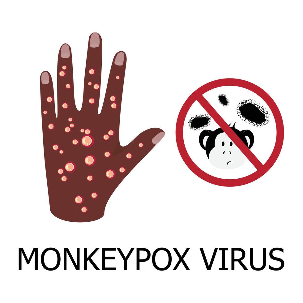 illustration des konzepts des affenpockenvirus. Afrikanische Hand mit dunkler Haut und Hautausschlag durch das Affenpockenvirus. stoppschild mit viruszellen und affengesicht. medizinisches Konzept. vektor