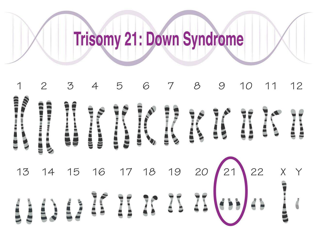 trisomi 21 downs syndrom karyotyp vektor