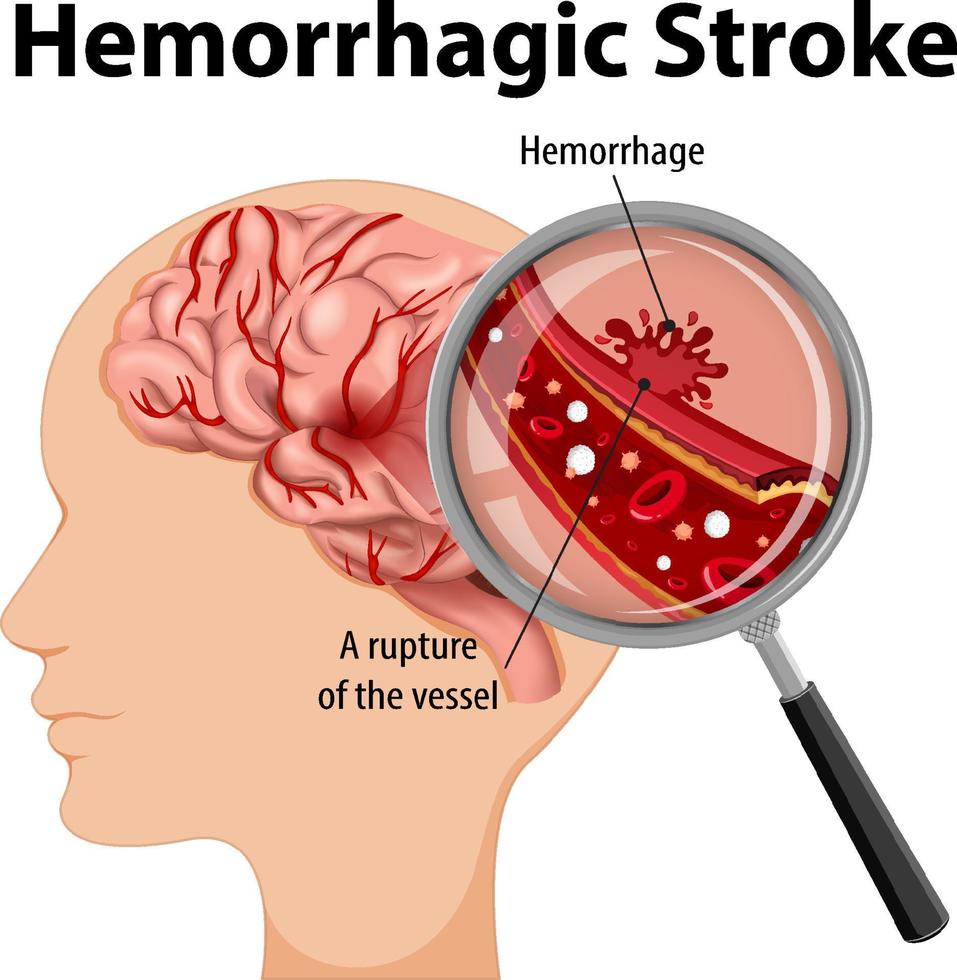 Mensch mit hämorrhagischem Schlaganfall vektor